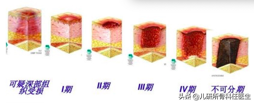 院外指导｜骨折了打石膏，骨科医生教你理顺和它相处的日日夜夜