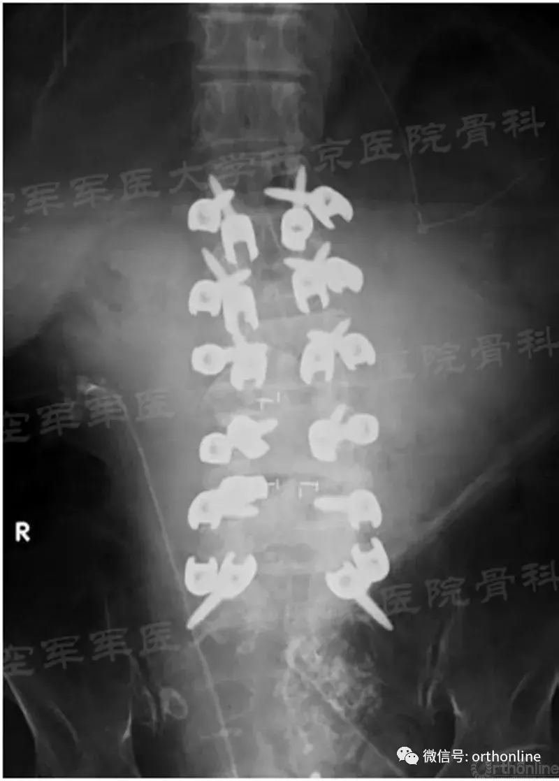 皮质骨螺钉在翻修手术中的应用