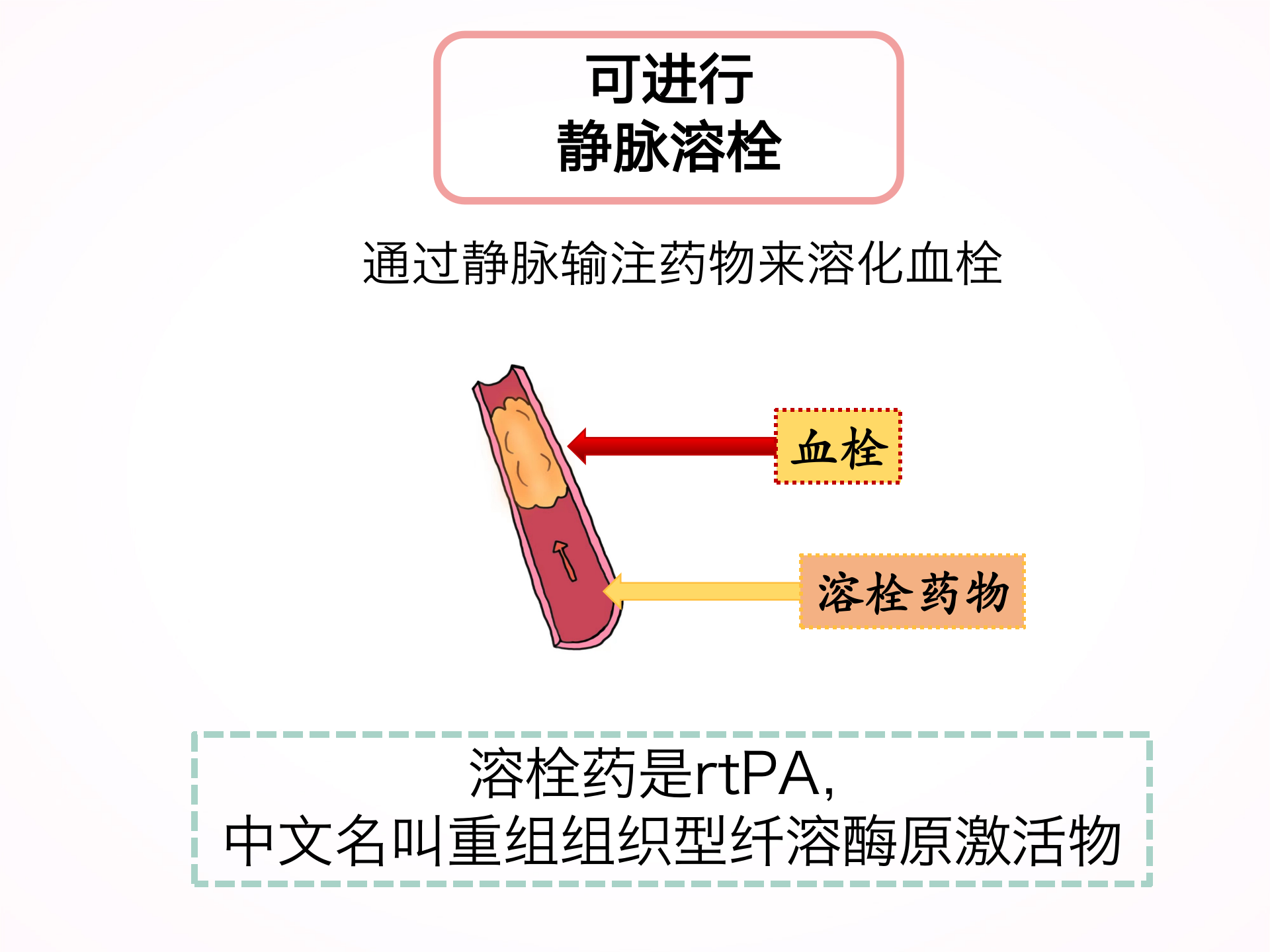 您为什么要选择静脉溶栓？