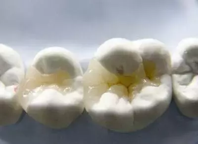 补牙价格差异如此巨大,你不知道的补牙“秘密”全都在这里!