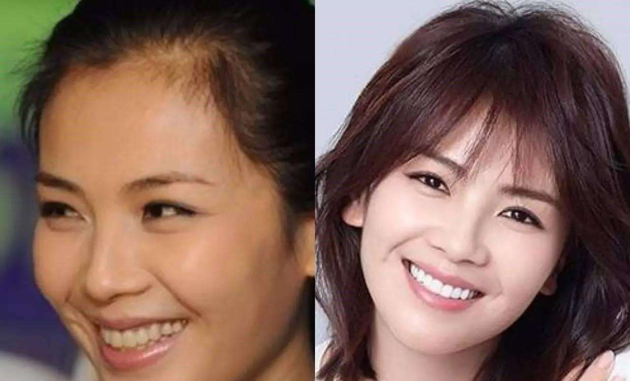 刘涛悔青肠子的同款烤瓷牙,满口300万,结果牙齿会发光?