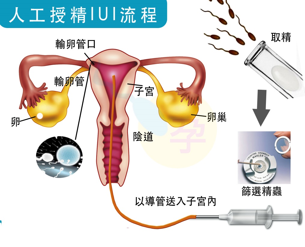 看呆医生：一次成功！医院人工授精太贵，英女子购买针筒自行操作