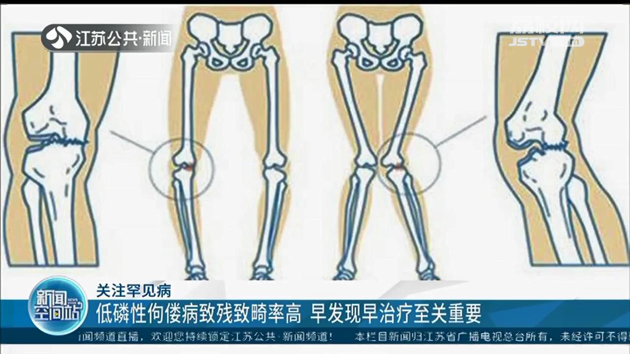 关注罕见病：低磷性佝偻病致残致畸率高 早发现早治疗至关重要