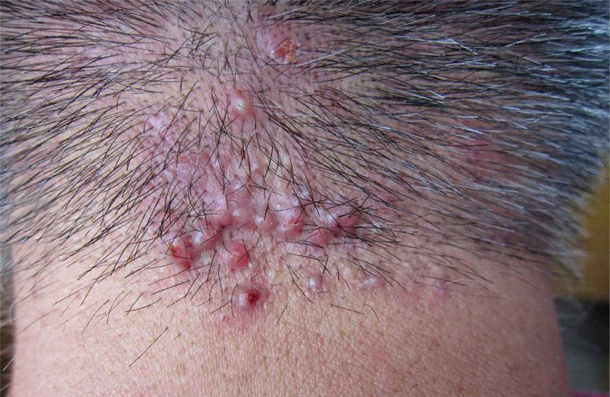 毛囊炎是什么症状图片(项部瘢痕疙瘩性毛囊炎) - 赤虎壹号