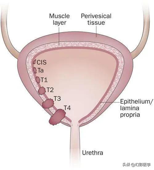 膀胱肿瘤术后如何规范实施灌注化疗，建议收藏
