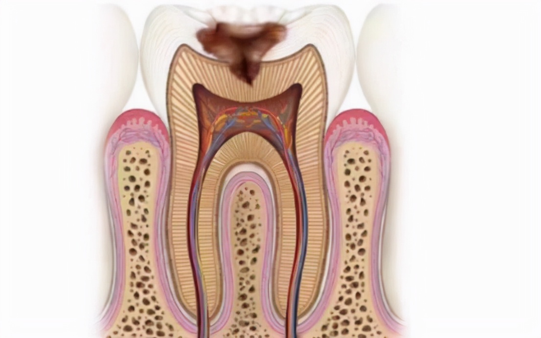 疼痛,疼痛非常剧烈,难以忍受,即使没有受到刺激的情况下也会出现疼痛