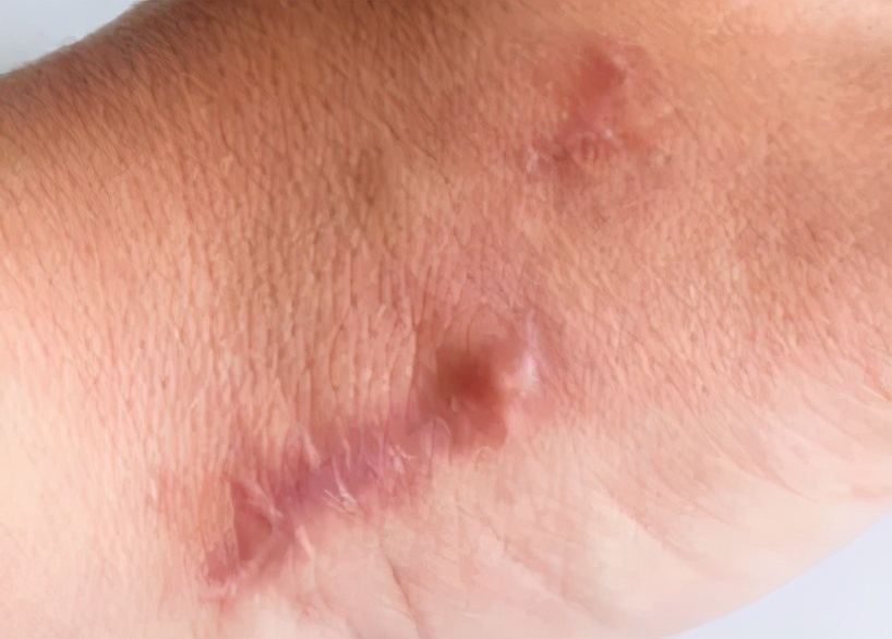 水痘和天花的区别图片(凹陷和凸起) - 赤虎壹号