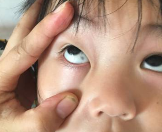 为啥孩子眼白有"黑点"?多半是这3个原因造成,家长没必要慌张