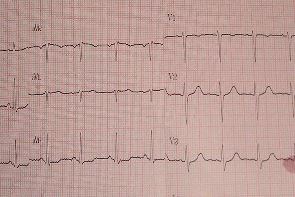 心电图st段出现改变,严重吗?什么情况下,心电图有这样的改变?