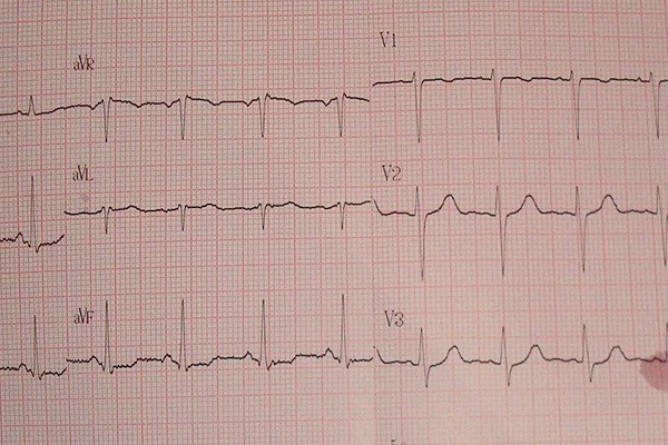 什麼情況下,心電圖有這樣的改變?