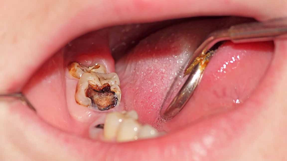 不能治愈的干槽症,到底是怎么回事?拔牙必看