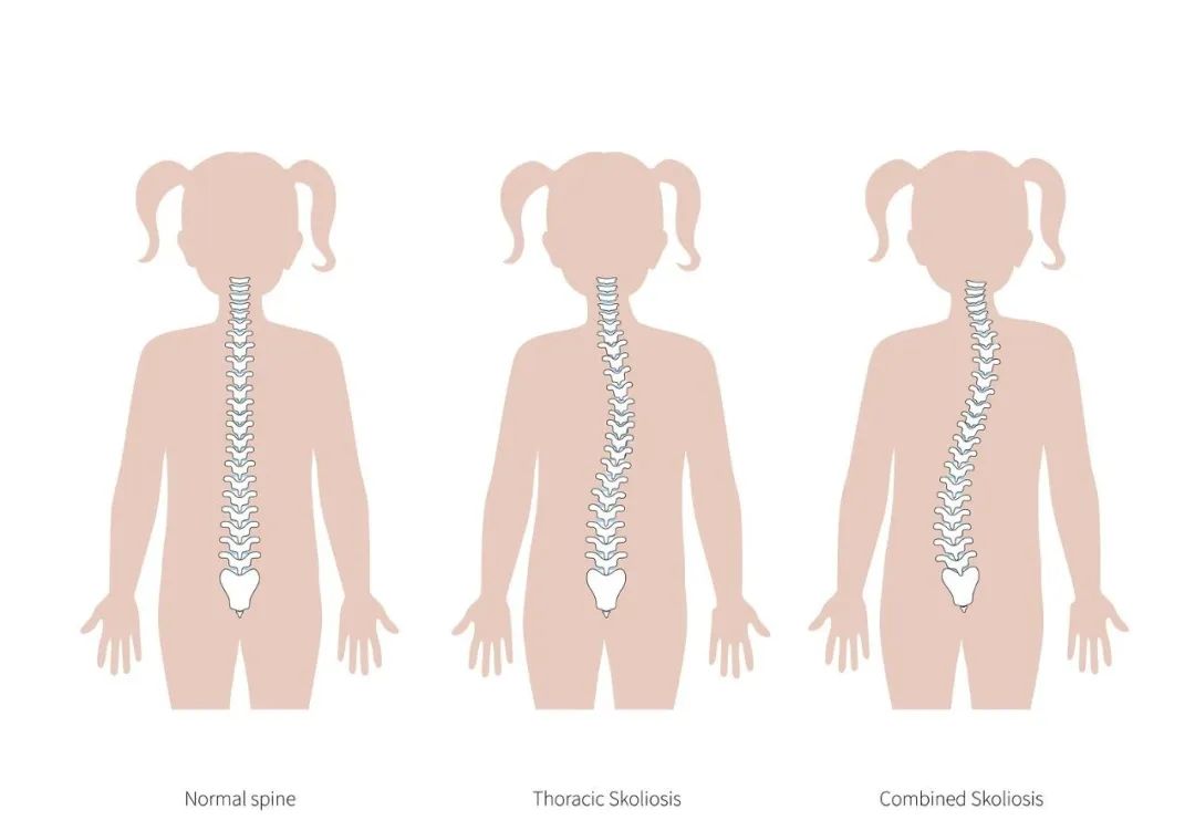 家长注意！比孩子驼背更吓人的竟是脊柱侧弯（附自检与改善方法）