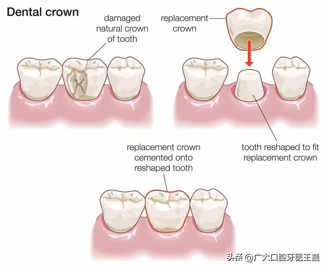 目前一般只有3种情况需要使用牙冠.