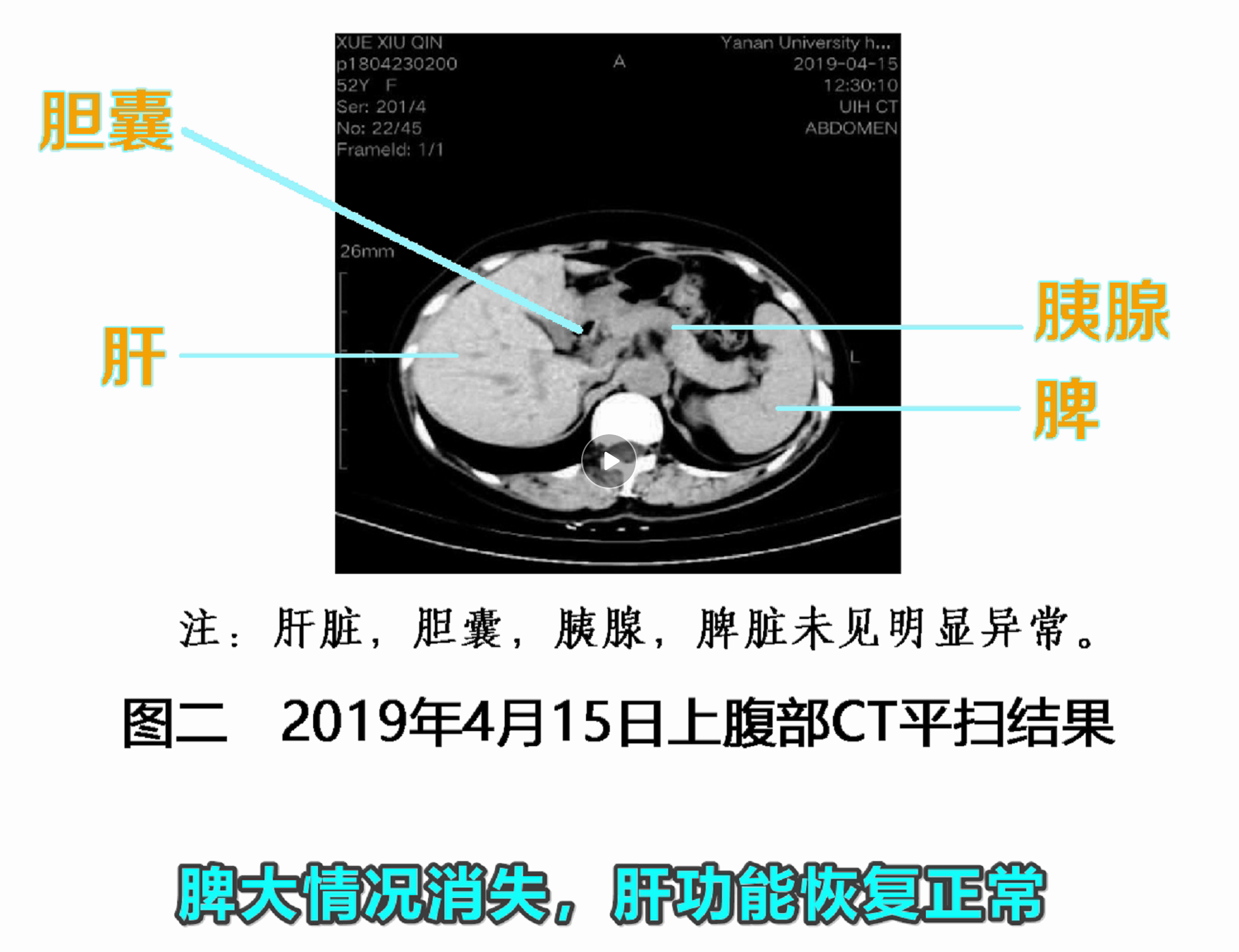 干扰素，逆转1例乙肝肝硬化的病人，为什么它却得不到全面应用？