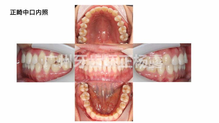 广州牙齿矫正杨露隐适美隐形矫正戴牙套全案例