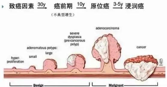 误把肠癌便血当痔疮，医生提醒：通过5点来分辨，早诊断早安心