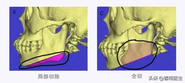 天下所有的削骨手术都会导致“脸垮”吗?