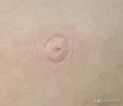 对于接受胰岛素治疗的糖尿病人来说，哪个牌子的无针注射器更好用