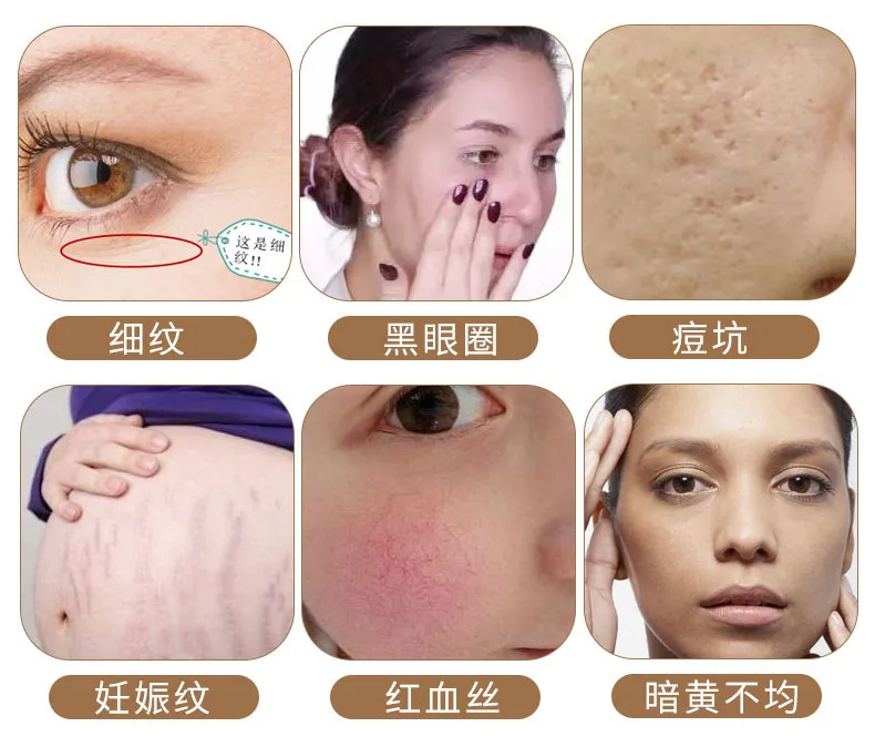 水光针 VS 微针,终于知道谁更适合我啦