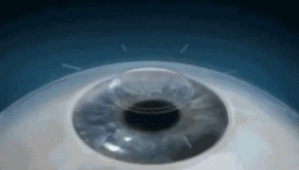 高考升学体检将至，你还在纠结选择哪种手术吗？