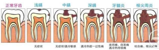 牙神经疼怎么办？