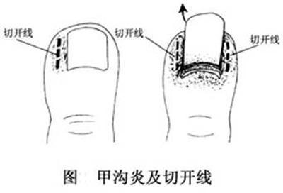 一个小妙招，甲沟炎不再发，王医生教您怎么做