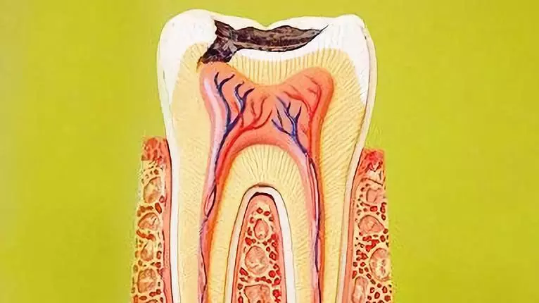 当智齿碰上急性牙髓炎，是直接拔除还是开髓后拔除？#雅悦齿科#