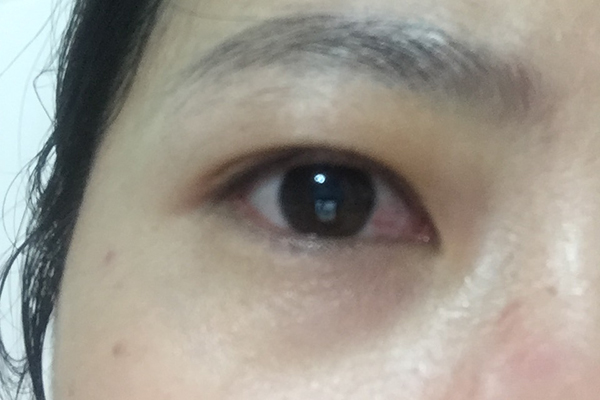 激光治療近視眼的危害（第一批用激光手術(shù)治近視的人，現(xiàn)在眼睛怎么樣了？有后遺癥嗎？）