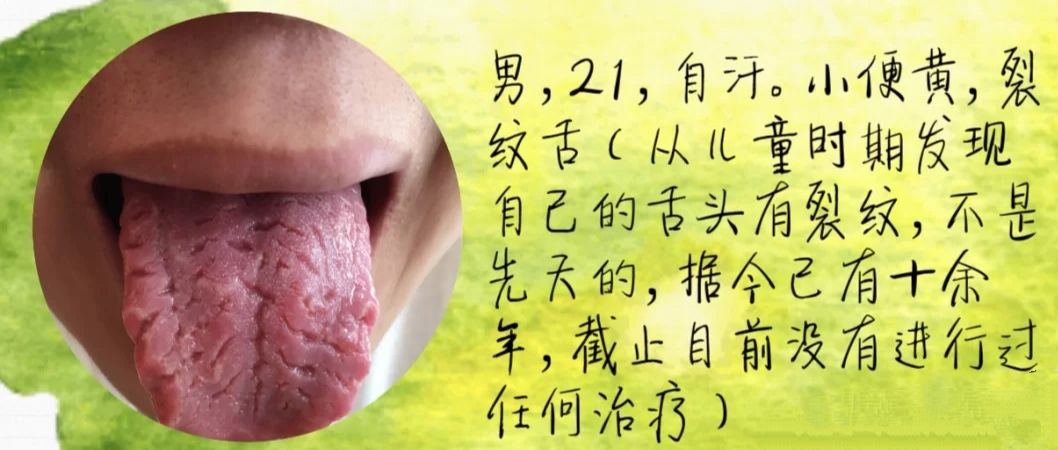 舌头有裂纹是怎么回事？常见的裂纹舌辩证，看看你是哪一种？