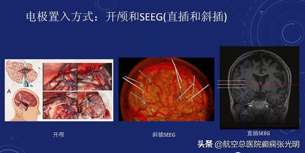 浅谈岛叶癫痫，什么都不像是其症状学特征