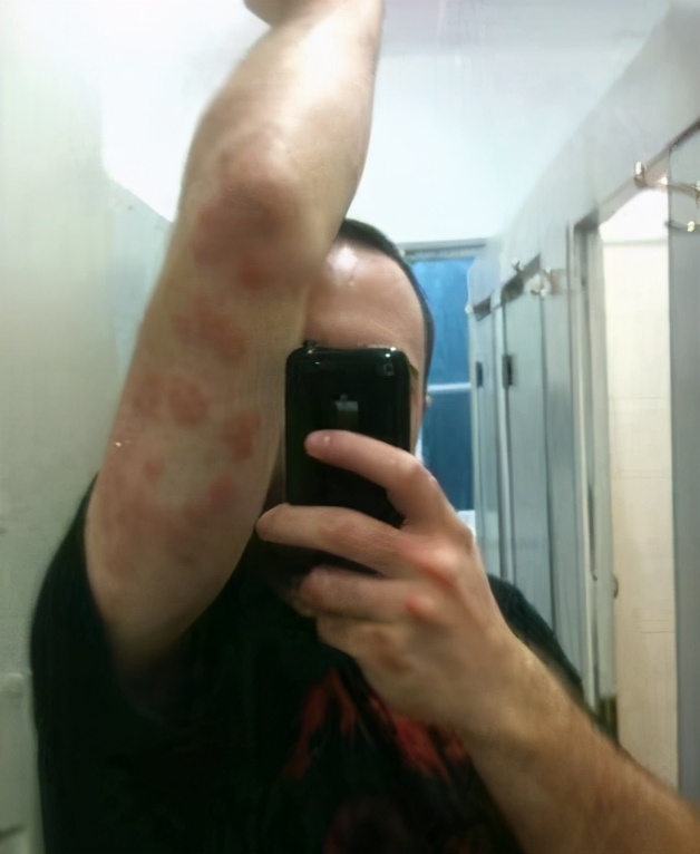 登革热症状(登革热症状红点图片)