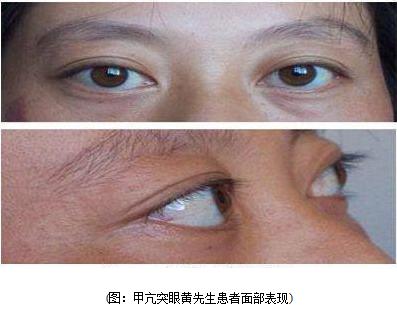 18岁学生,被同学叫"青蛙眼",竟是甲亢,5个方面教你识别甲亢