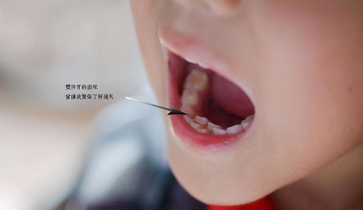 婴儿牙缝隙大怎么办(宝宝长出吓人的双排牙 乐宝宝贝