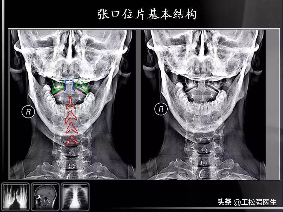 颈椎X光片