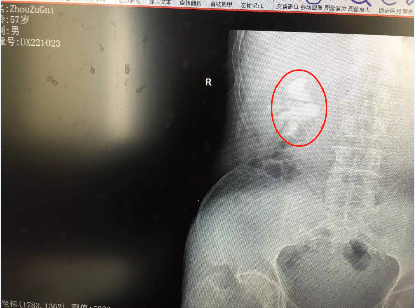 突发腰痛别小视！湖北大叔突感腰痛经查结石严重致肾功能受损
