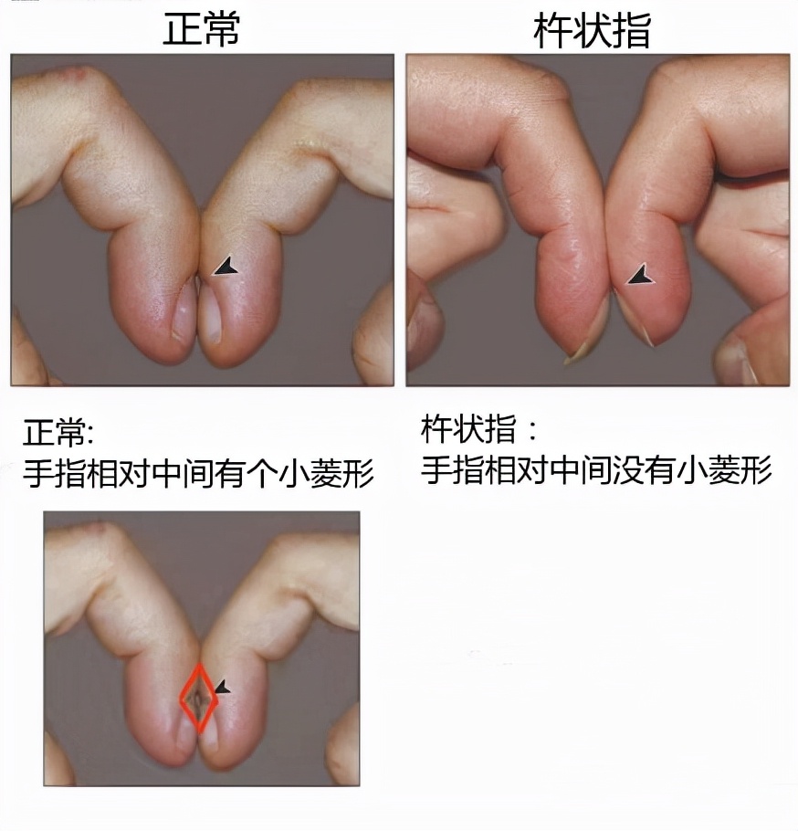 一個動作簡單判斷自己有沒有杵狀指