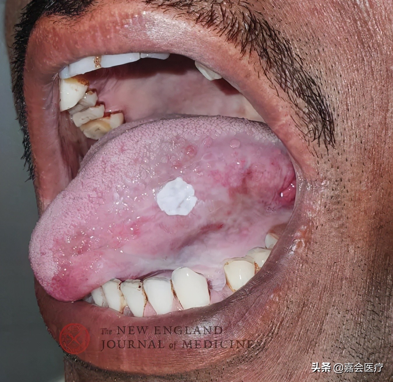 舌头白斑病图片