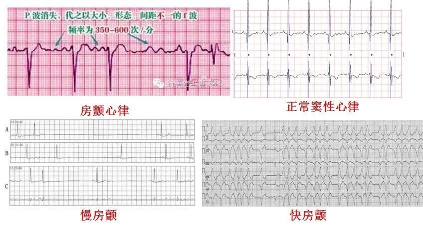 1份30元的心电图，可直接诊断出5种常见心脏病，辅助诊断4种病