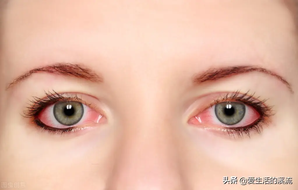 红眼病怎么治疗最有效（红眼病外治有方）