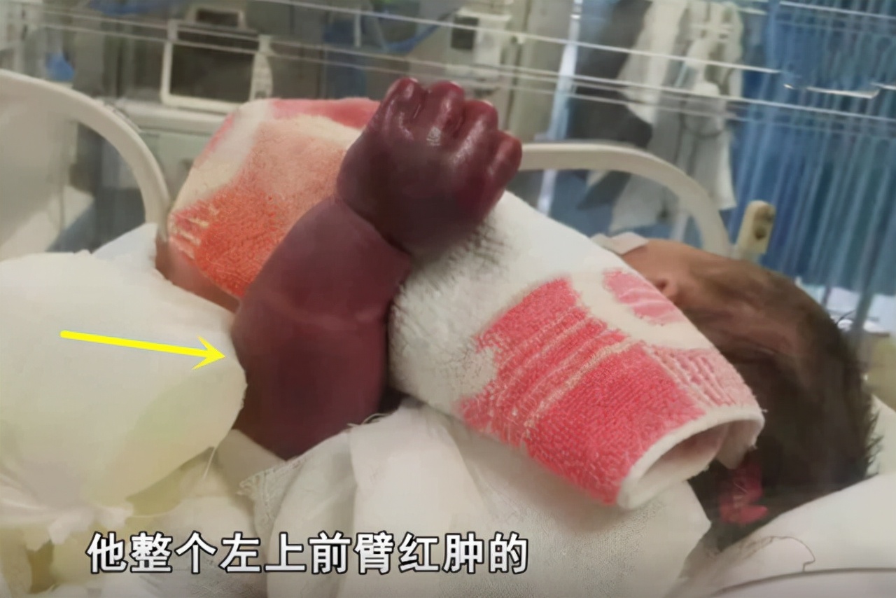 婴儿一条腿粗一条腿细（心疼）