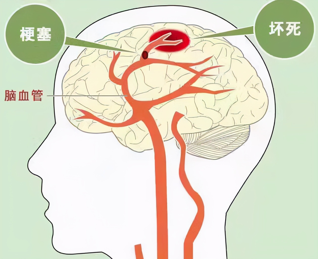 脑梗死治疗方法及病因解析