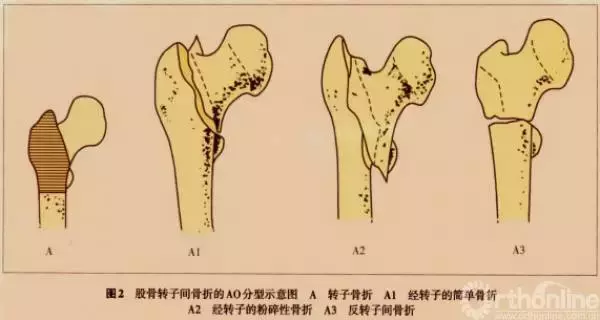 刘强：骨质疏松性股骨转子间骨折的治疗