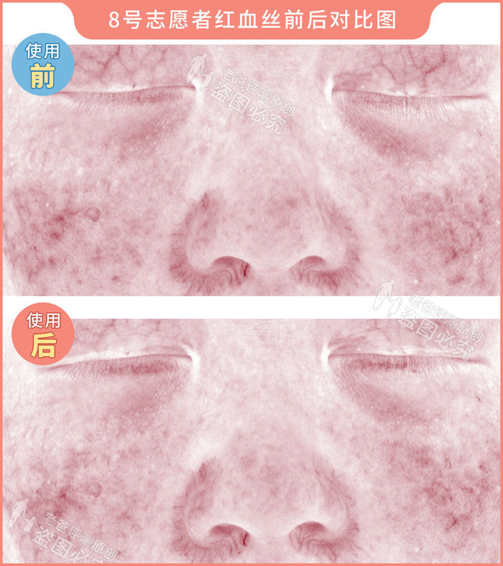 网红家用美容仪真的有效吗？2个多月的跟踪实测结果来了