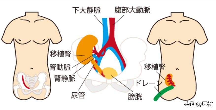 给亲属捐赠一个肾脏，对身体有什么影响？