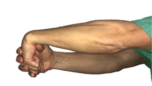 网球肘康复率(网球肘的治疗与康复(二))