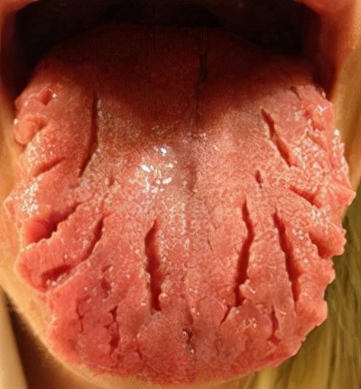 婴儿舌头破皮图片图片