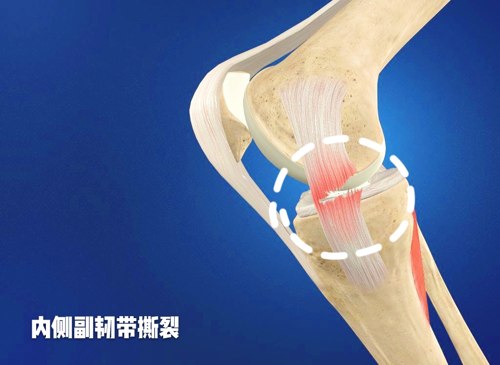 膝盖疼，就是得滑膜炎了？医生辟谣，教您一步步判断自己的病因