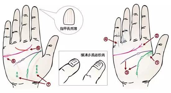 掌纹诊病：可以诊断肝癌、糖尿病、高血压、妇科病、脑溢血