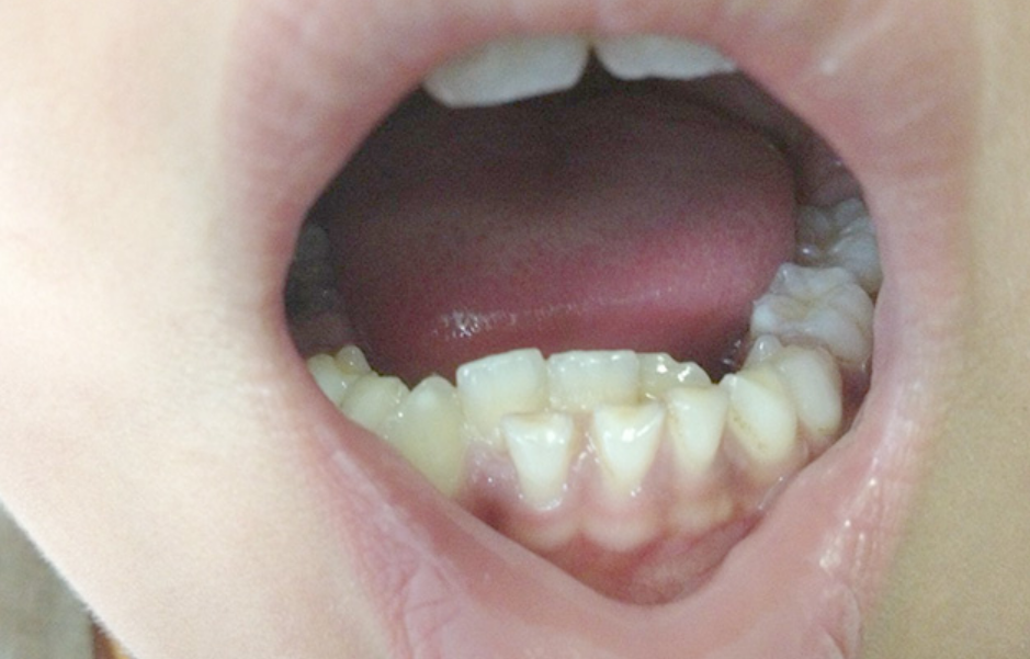 萌娃乳牙很漂亮,没成想换牙后牙齿却"歪七扭八",宝妈直言:还不如乳牙