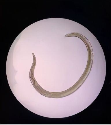 惊！男孩眼里长出6条活虫，预防只需做好这件事